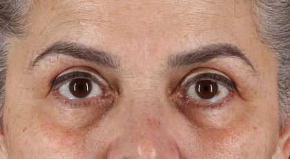Blepharoplasty (Eyelid Surgery) Before & After Patient #4614