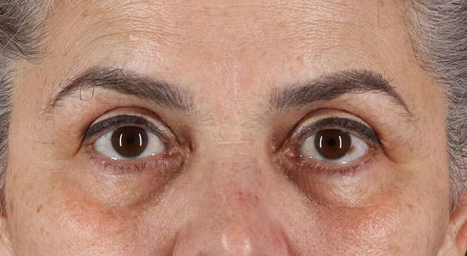Blepharoplasty (Eyelid Surgery) Before & After Patient #4614