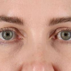 Blepharoplasty (Eyelid Surgery) Before & After Patient #4617