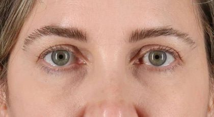 Blepharoplasty (Eyelid Surgery) Before & After Patient #4617