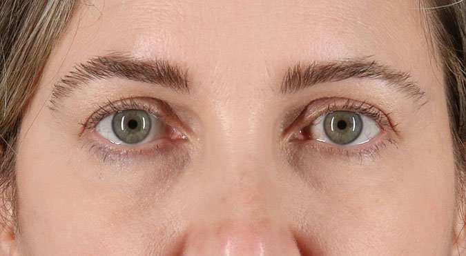 Blepharoplasty (Eyelid Surgery) Before & After Patient #4617