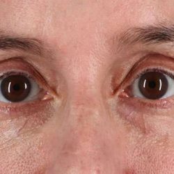 Blepharoplasty (Eyelid Surgery) Before & After Patient #4620