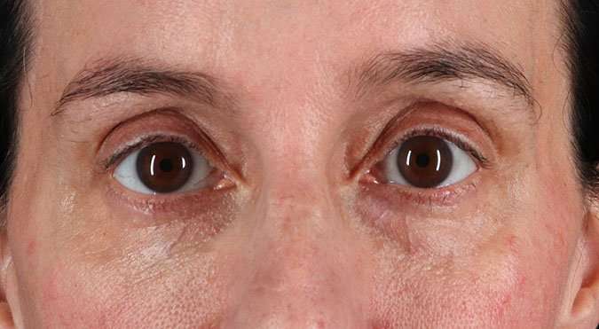 Blepharoplasty (Eyelid Surgery) Before & After Patient #4620