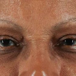 Blepharoplasty (Eyelid Surgery) Before & After Patient #4623