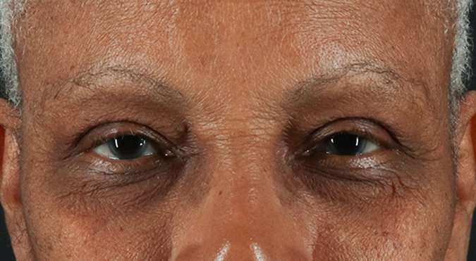 Blepharoplasty (Eyelid Surgery) Before & After Patient #4623