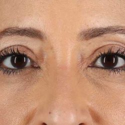 Blepharoplasty (Eyelid Surgery) Before & After Patient #4626