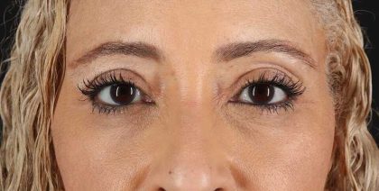 Blepharoplasty (Eyelid Surgery) Before & After Patient #4626