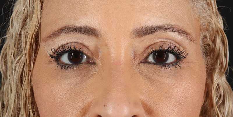 Blepharoplasty (Eyelid Surgery) Before & After Patient #4626