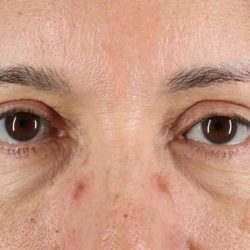 Blepharoplasty (Eyelid Surgery) Before & After Patient #4629