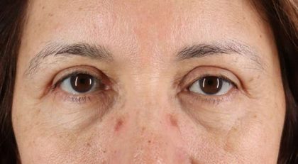 Blepharoplasty (Eyelid Surgery) Before & After Patient #4629