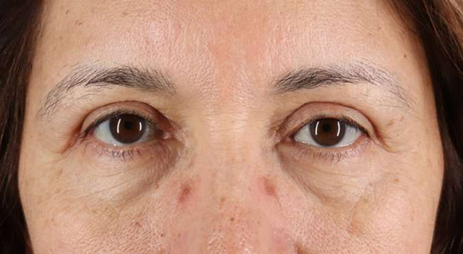 Blepharoplasty (Eyelid Surgery) Before & After Patient #4629