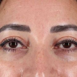 Blepharoplasty (Eyelid Surgery) Before & After Patient #4632