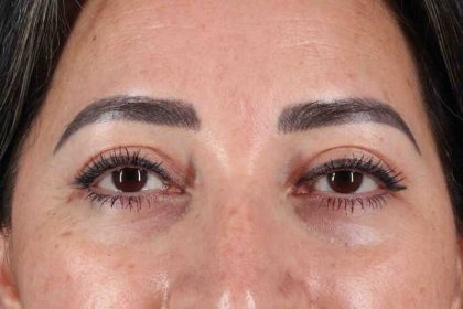 Blepharoplasty (Eyelid Surgery) Before & After Patient #4632