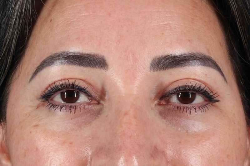 Blepharoplasty (Eyelid Surgery) Before & After Patient #4632