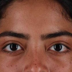 Blepharoplasty (Eyelid Surgery) Before & After Patient #4635