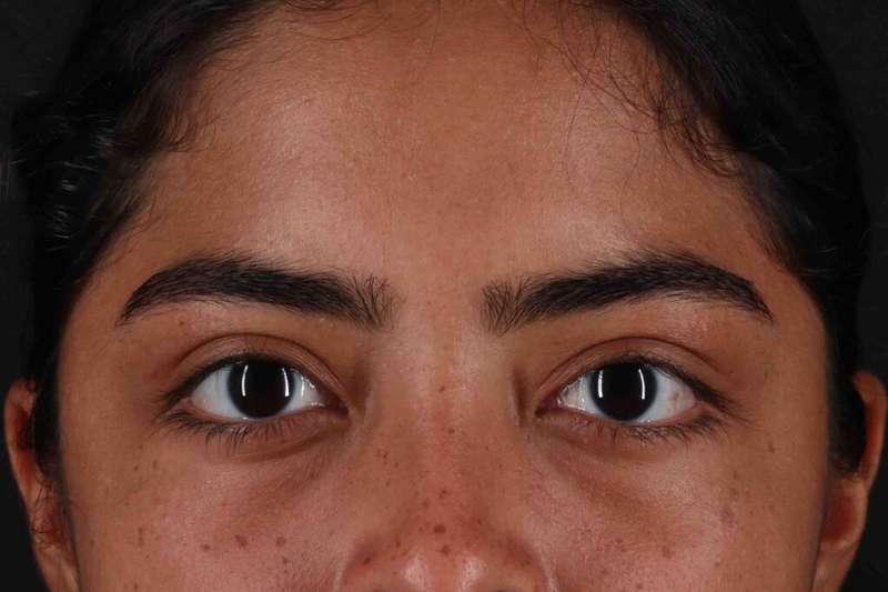 Blepharoplasty (Eyelid Surgery) Before & After Patient #4635