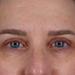 Blepharoplasty (Eyelid Surgery) Before & After Patient #4638