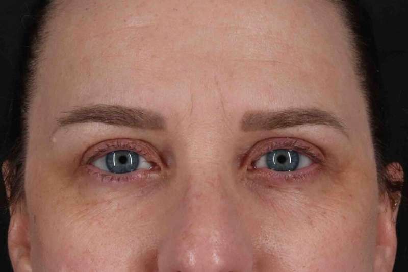 Blepharoplasty (Eyelid Surgery) Before & After Patient #4638