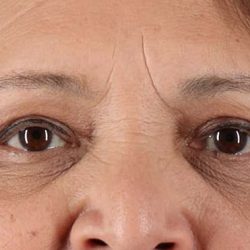 Blepharoplasty (Eyelid Surgery) Before & After Patient #4649