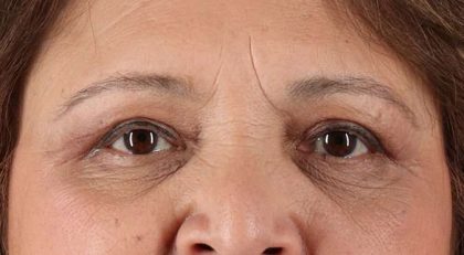 Blepharoplasty (Eyelid Surgery) Before & After Patient #4649