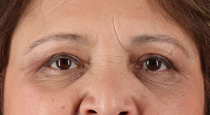 Blepharoplasty (Eyelid Surgery) Before & After Patient #4649
