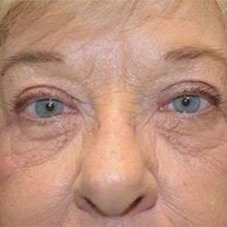 Brow Lift Before & After Patient #4652