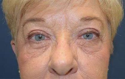 Brow Lift Before & After Patient #4652