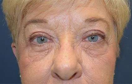 Brow Lift Before & After Patient #4652