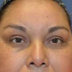 Brow Lift Before & After Patient #4655