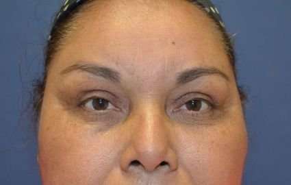 Brow Lift Before & After Patient #4655