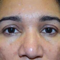 Brow Lift Before & After Patient #4658