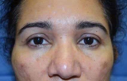 Brow Lift Before & After Patient #4658