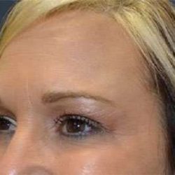 Brow Lift Before & After Patient #4661