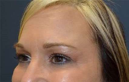 Brow Lift Before & After Patient #4661
