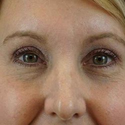 Brow Lift Before & After Patient #4672