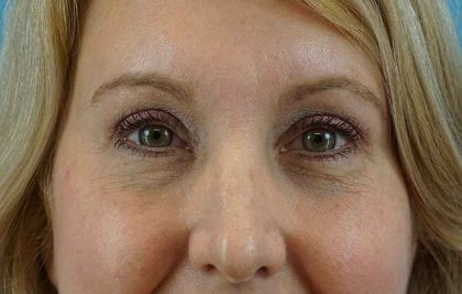 Brow Lift Before & After Patient #4672