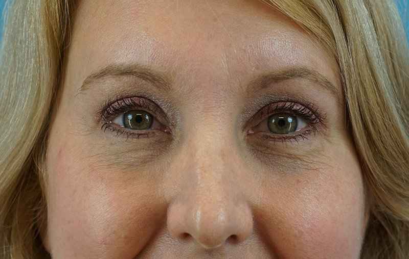 Brow Lift Before & After Patient #4672