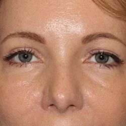 Brow Lift Before & After Patient #4679