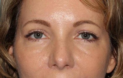 Brow Lift Before & After Patient #4679