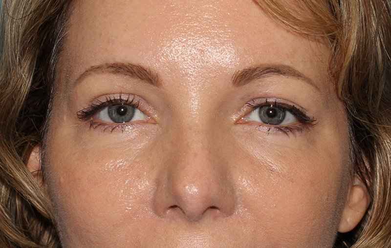 Brow Lift Before & After Patient #4679