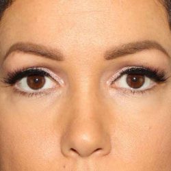 Brow Lift Before & After Patient #4690