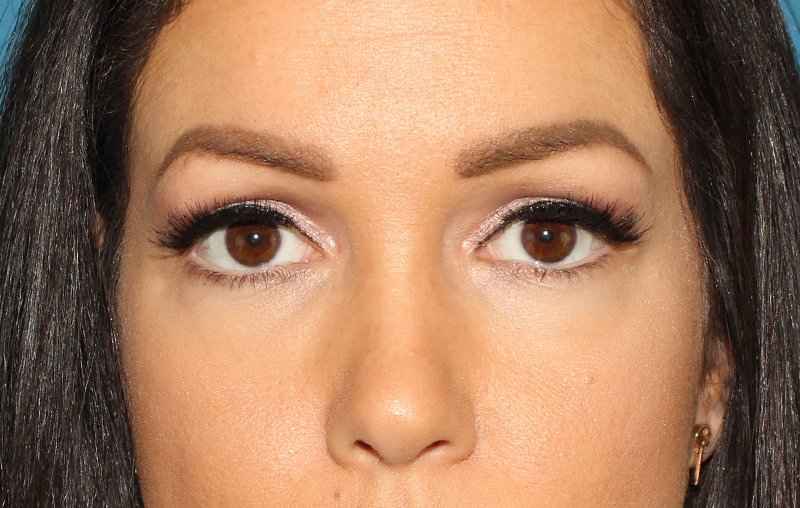 Brow Lift Before & After Patient #4690