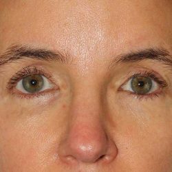 Brow Lift Before & After Patient #4697