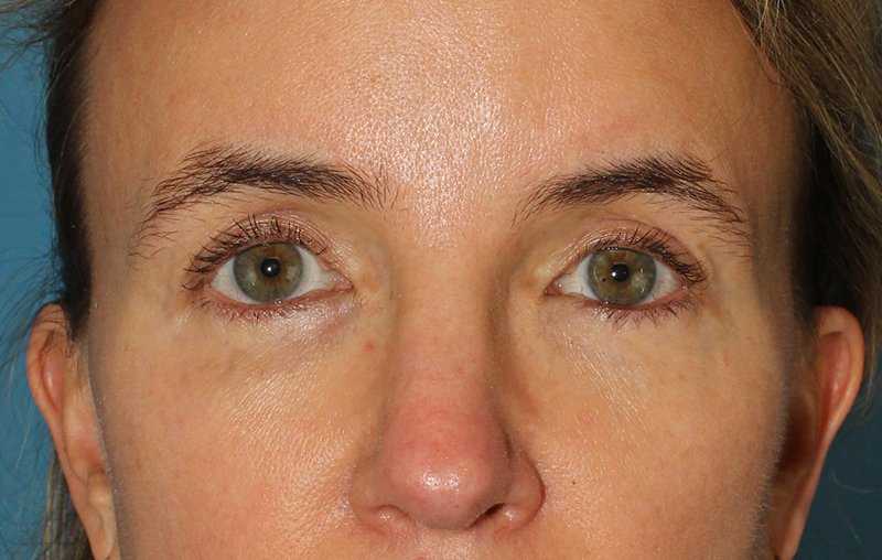 Brow Lift Before & After Patient #4697