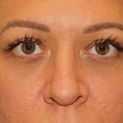 Brow Lift Before & After Patient #4700