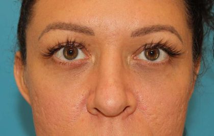 Brow Lift Before & After Patient #4700