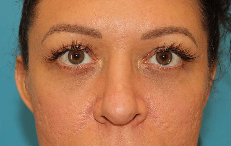 Brow Lift Before & After Patient #4700
