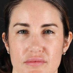 Brow Lift Before & After Patient #4711