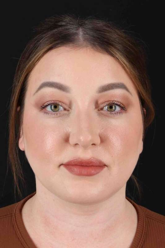 Brow Lift Before & After Patient #4722
