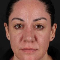 Brow Lift Before & After Patient #4733
